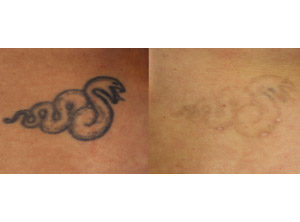 Scopri di più sull'articolo Stop tatuaggi: nuove sensazioni di libertà